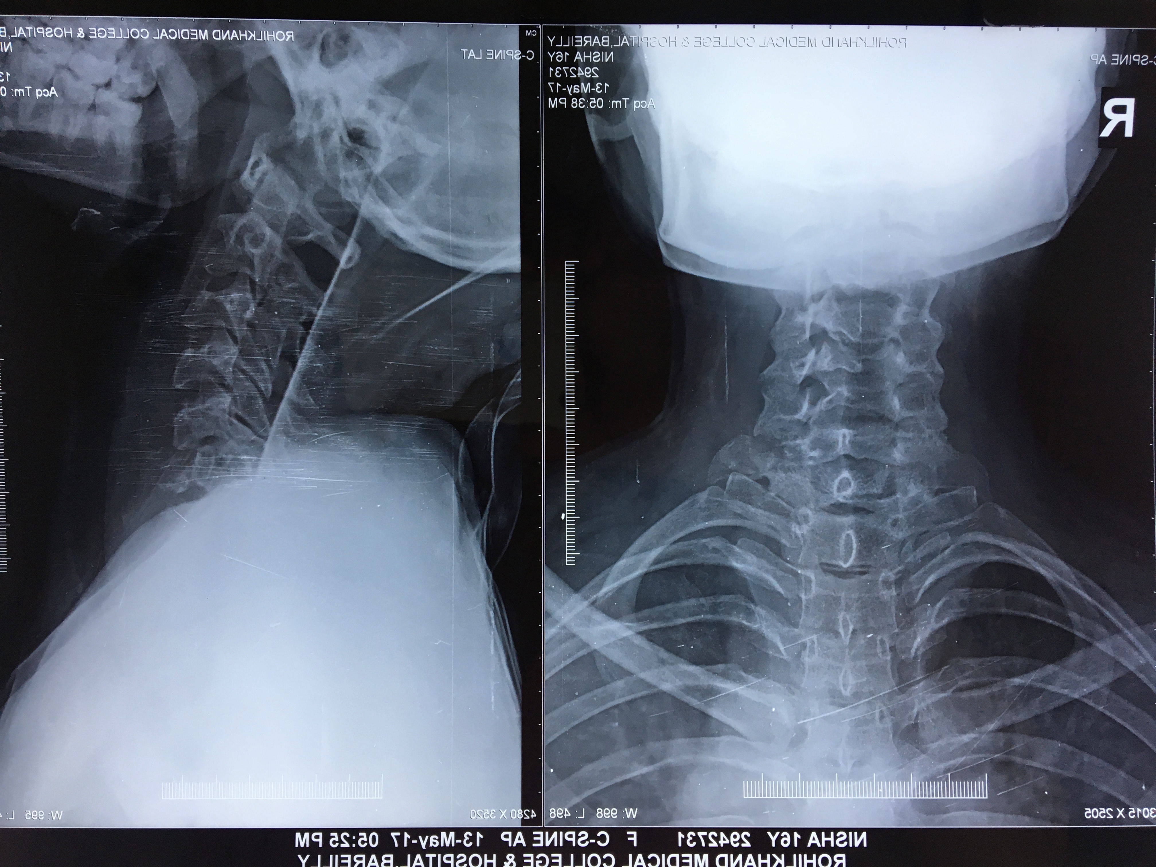 Caries C6/C7/T1 Managed With Anterior Corpectomy And Plating